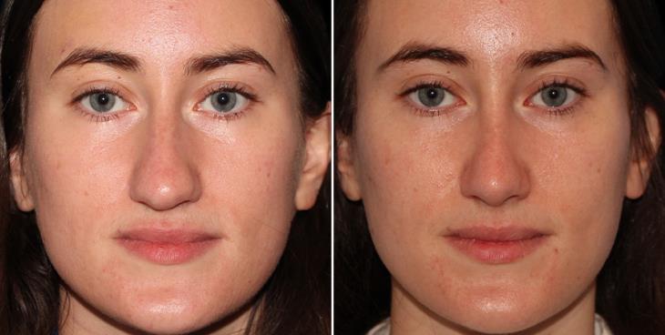 Scarless Nose Surgery Results In Atlanta GA